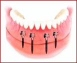 Mini Iimplant Retained Dentures