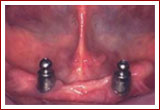 Implant Retained Dentures