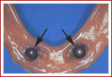 Implant Retained Dentures